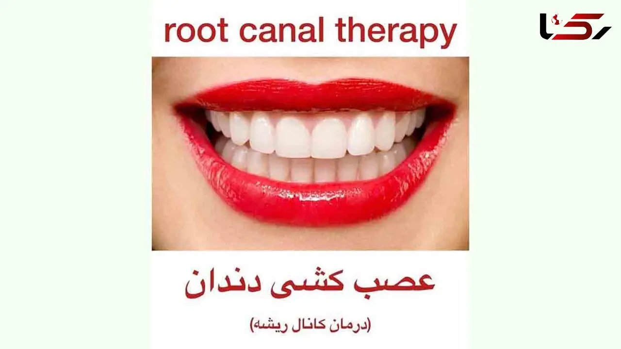 عصب کشی دندان چگونه است؟ + فیلم