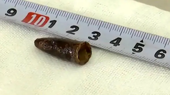 خارج‌کردن درِ خودکار از ریه مرد 33 ساله + عکس 