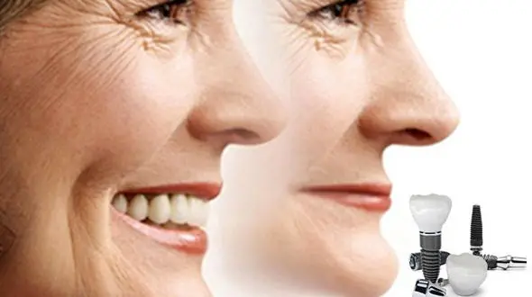 پیشگیری از پیری زودرس چهره با ایمپلنت دندان
