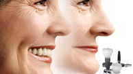 پیشگیری از پیری زودرس چهره با ایمپلنت دندان