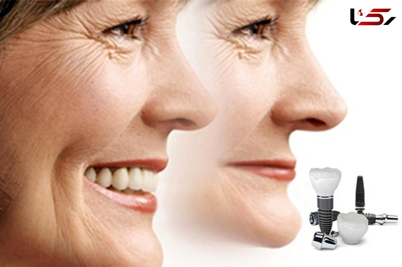 پیشگیری از پیری زودرس چهره با ایمپلنت دندان