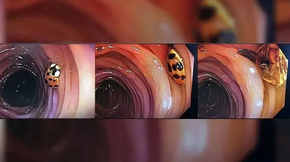 روده یک بیمار پزشکان را شوکه کرد / عکس