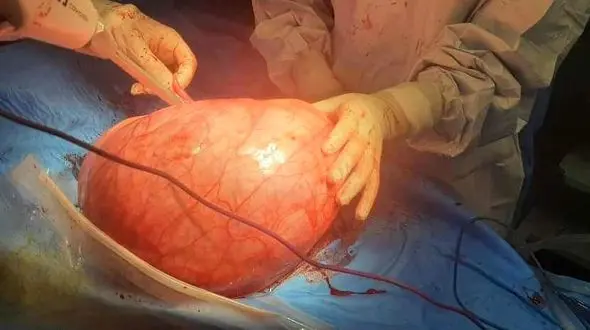 شکم برآمده زن مشهدی 6 کیلو وزن داشت! / 90 دقیقه حساس در اتاق عمل