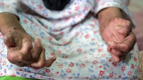 جذام در ایران؛ آخرین وضعیت ابتلا به این بیماری در کشور 