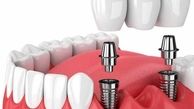 مزایا و معایب ایمپلنت دندان چیست؟