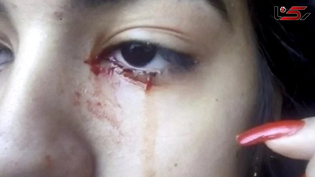 دختری 15 ساله که خون گریه می کند  + عکس