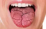 خشکی دهان نشانه چیست؟ + 15 جدول جالب درباره خشکی دهان