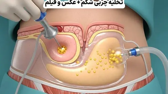 تخلیه چربی شکم + عکس و فیلم