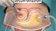 تخلیه چربی شکم + عکس و فیلم