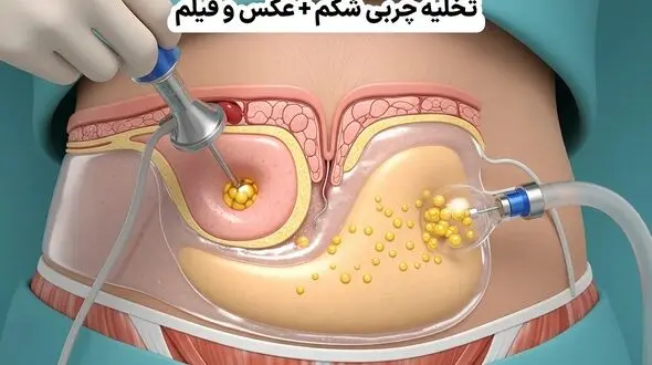 تخلیه چربی شکم + عکس و فیلم