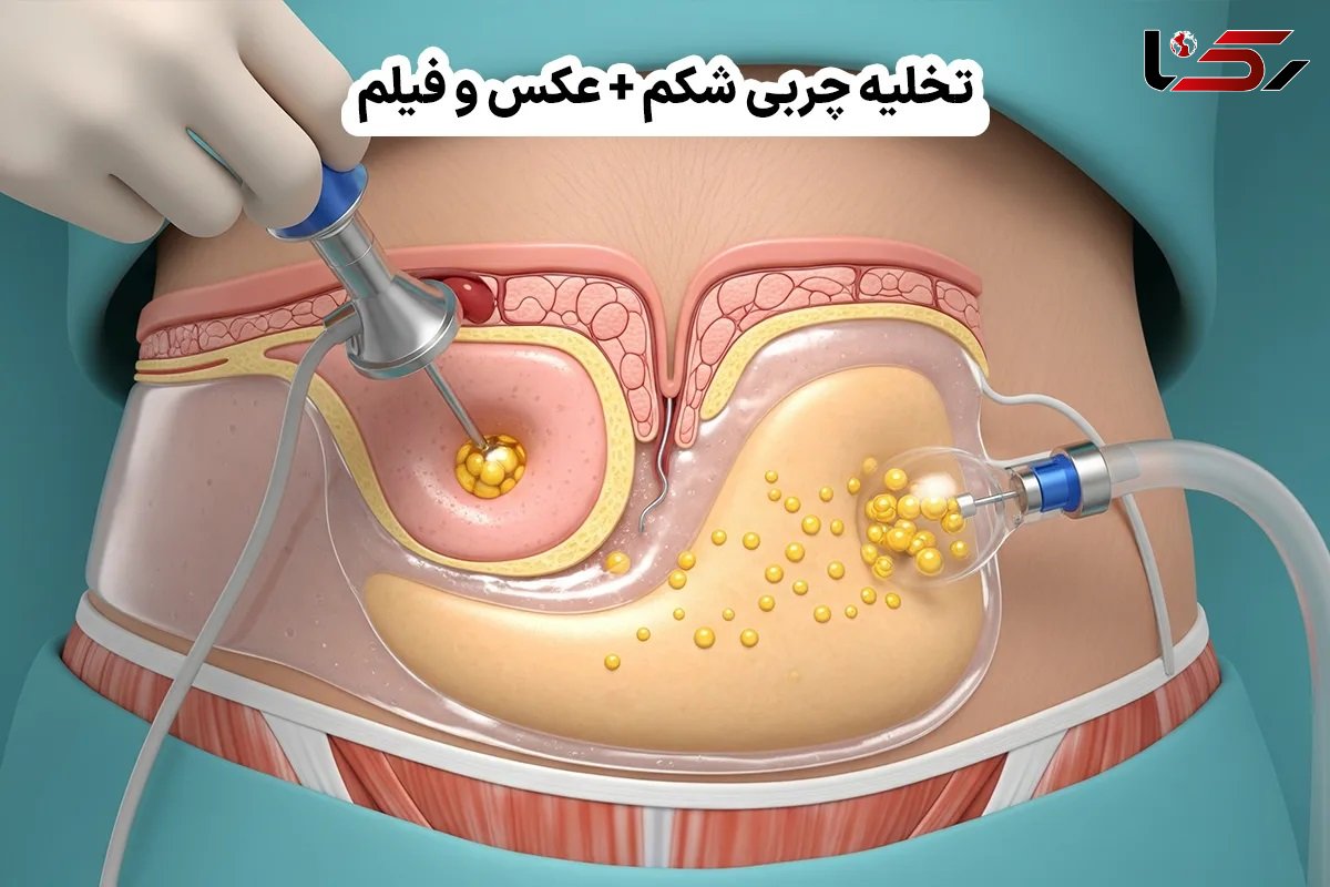 تخلیه چربی شکم + عکس و فیلم