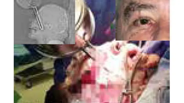 عکس وحشتناک از فرو رفتن دسته ماهیتابه در چشم  آشپز + جزییات