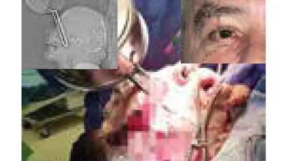 عکس وحشتناک از فرو رفتن دسته ماهیتابه در چشم  آشپز + جزییات