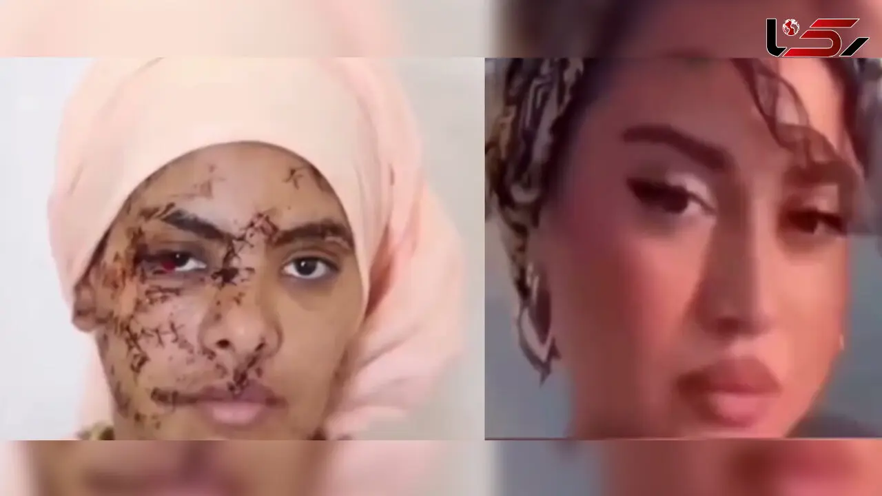 فیلم 130 بخیه بر صورت و دستان زن جوان /  شوهر سابقش صورت زیبای او را با چاقو خط خطی کرد