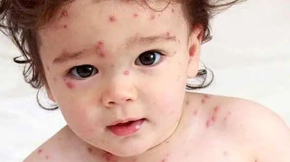 نشانه های بیماری آبله مرغان در کودکی