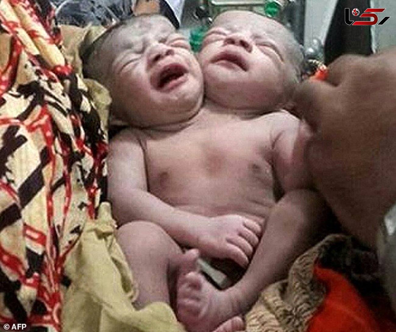 تولد نوزاد دو سر در بنگلادش