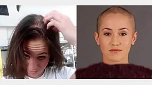 دختر 27 ساله در شب تولدش کچل  شد! / او تحت آزار قرار گرفته بود + عکس