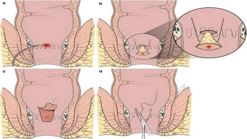 عمل فیستول چیست