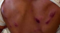 عکس تلخ از کبودی های دانش آموز فنوجی / تنبیه بدنی شدید توسط معلم