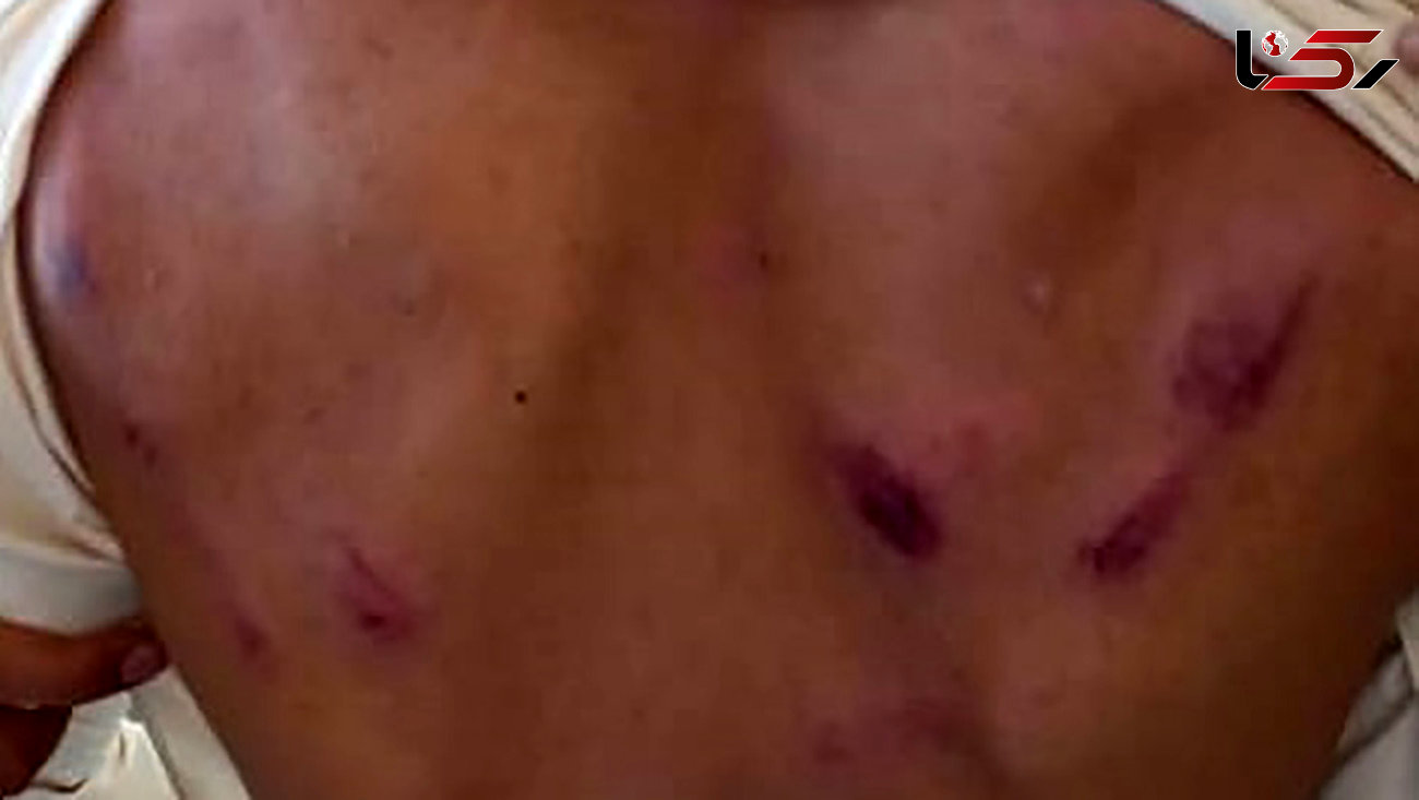 عکس تلخ از کبودی های دانش آموز فنوجی / تنبیه بدنی شدید توسط معلم