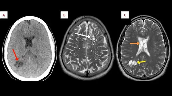 بیکن نیم پز، مرد 52 ساله را به انگل مغزی مبتلا کرد !