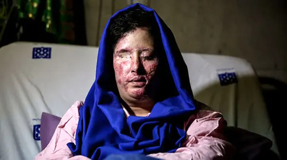 ناگفته های تلخ "سهیلا جورکِش" قربانی اسیدپاشی اصفهان از رنج‌هایش+عکس