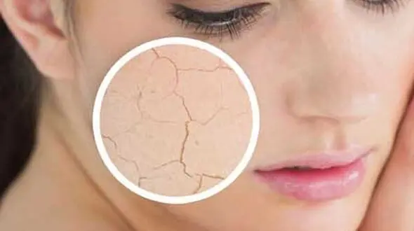 راه های ساده برای مقابله با خشکی پوست