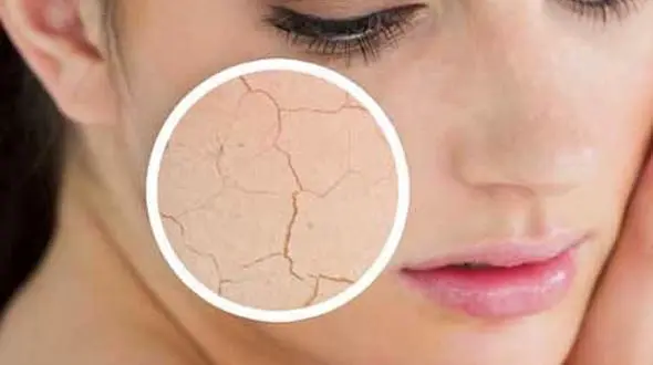 راه های ساده برای مقابله با خشکی پوست