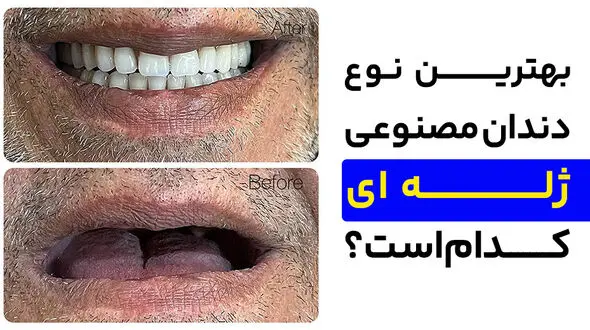 بهترین نوع دندان مصنوعی ژله ای کدام است؟