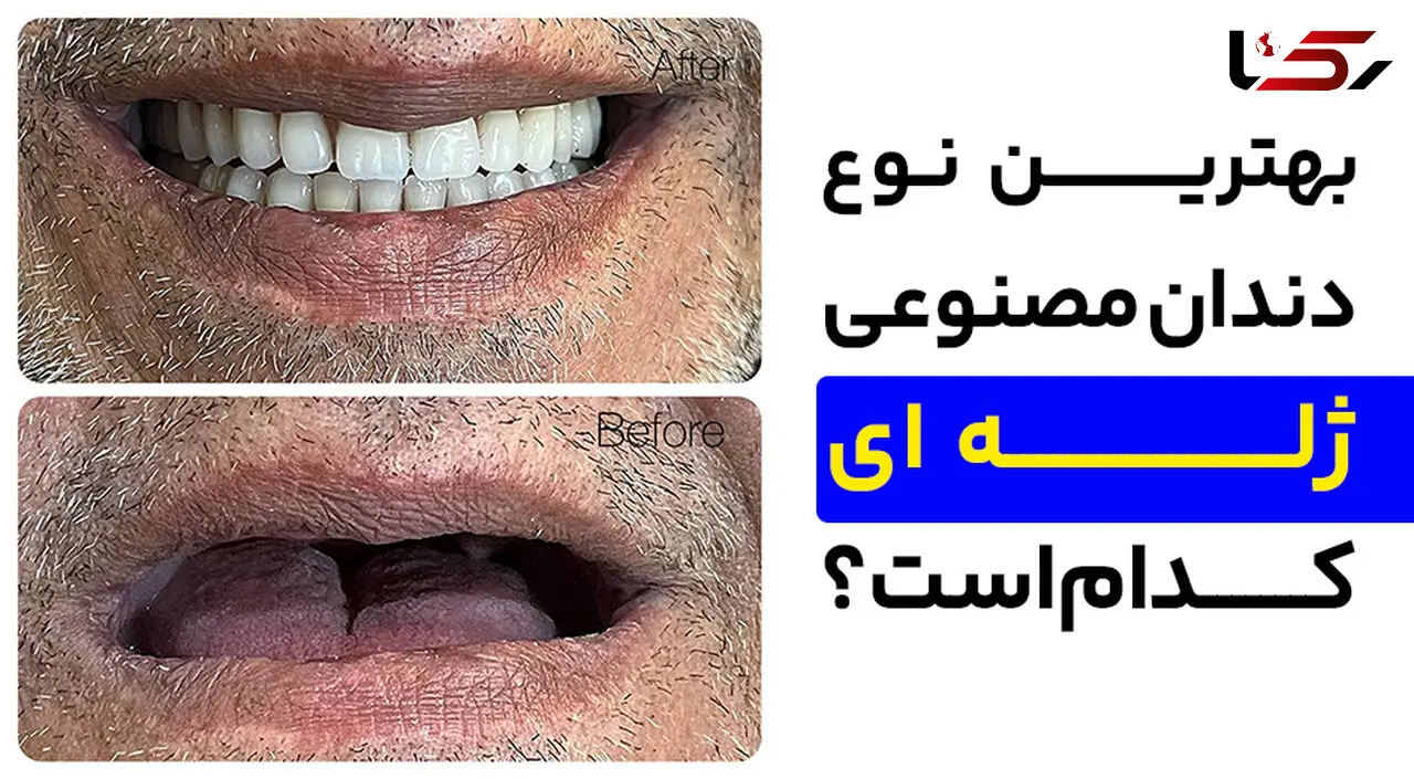 بهترین نوع دندان مصنوعی ژله ای کدام است؟