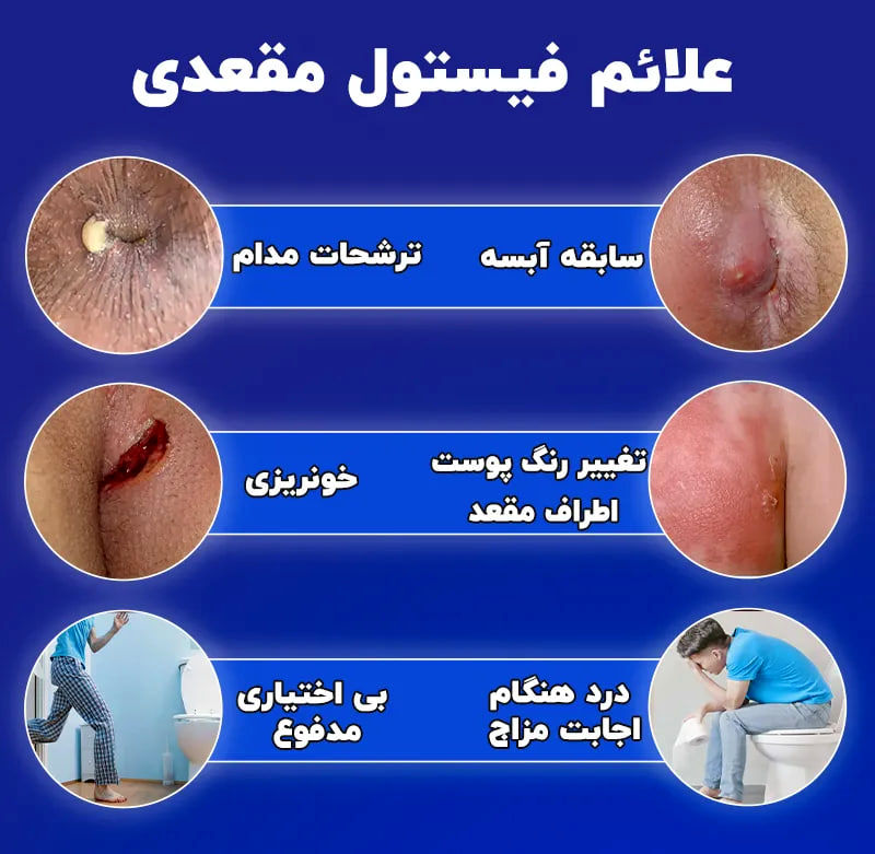 فیستول مقعدی