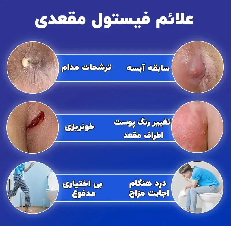فیستول مقعدی
