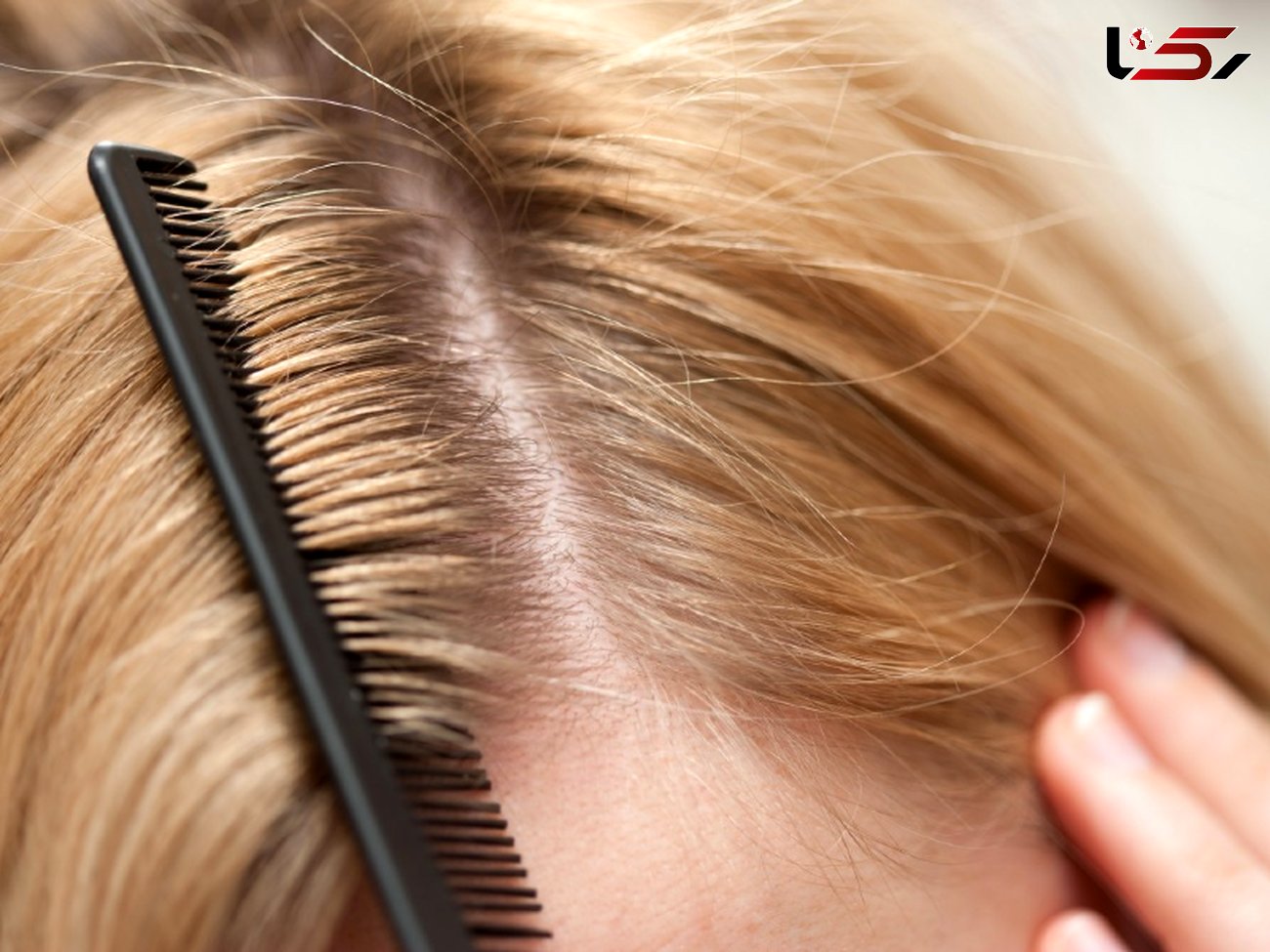 7 ترفند خانگی برای مبارزه با ریزش مو