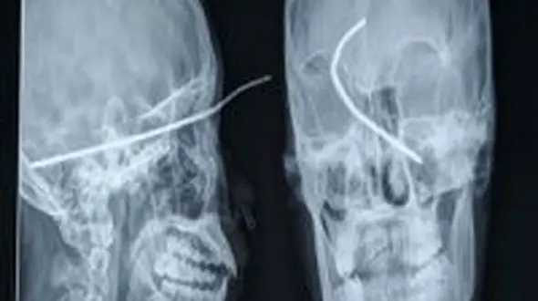 ابتلا به سرطان با پرتوهای رادیولوژی و سی تی اسکن