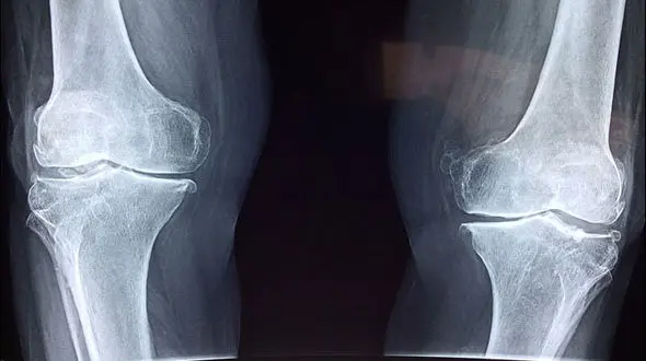 ساخت غضروف مصنوعی با ماده جلیقه ضد گلوله