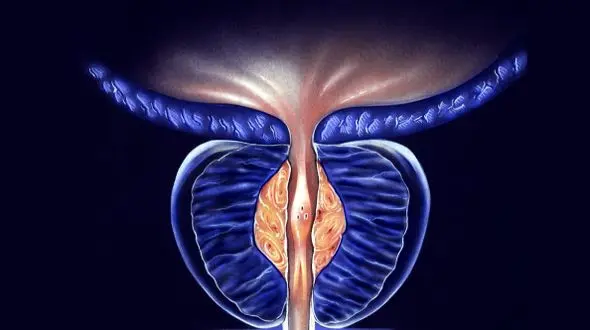 بزرگی پروستات یا سرطان پروستات؟ راهنمای تشخیص دقیق