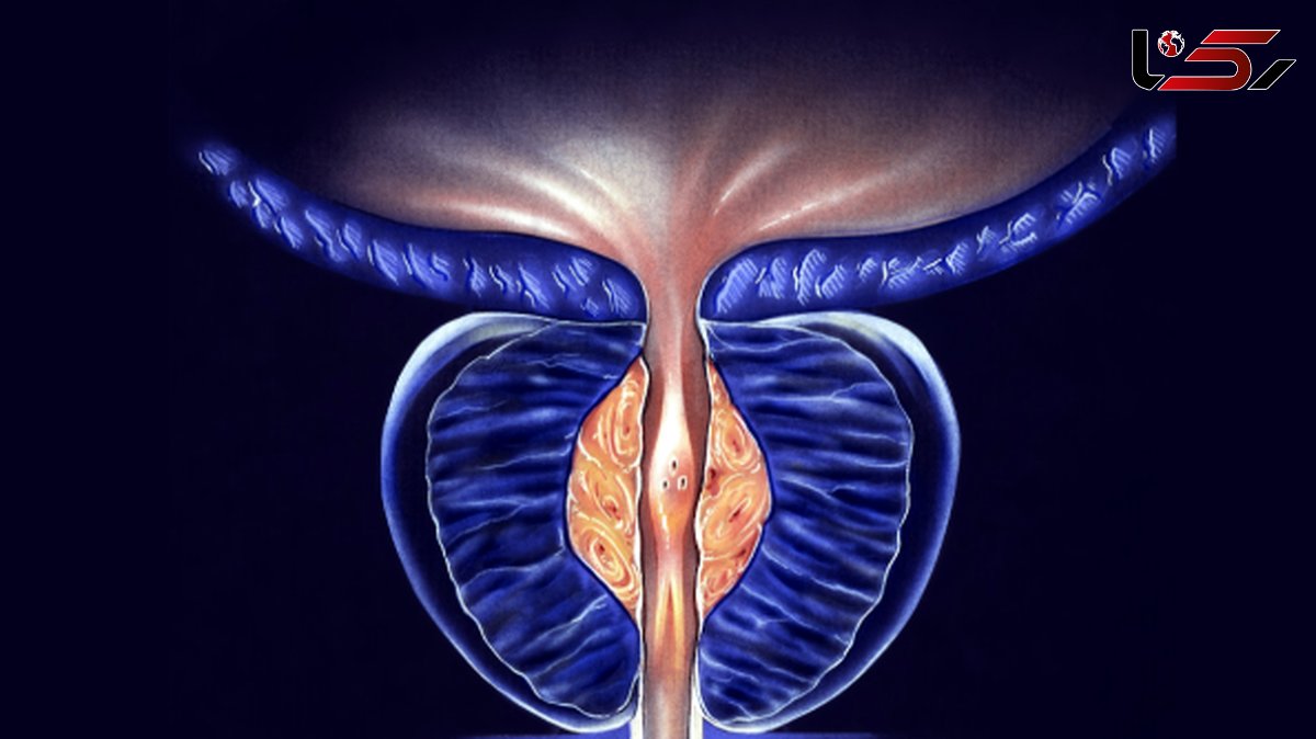  بزرگی پروستات یا سرطان پروستات؟ راهنمای تشخیص دقیق 
