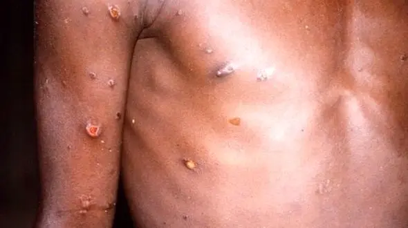 آبله میمون به امارات رسید