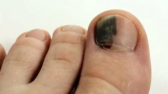 دلایل، علائم و درمان سیاهی ناخن پا