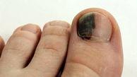 دلایل، علائم و درمان سیاهی ناخن پا