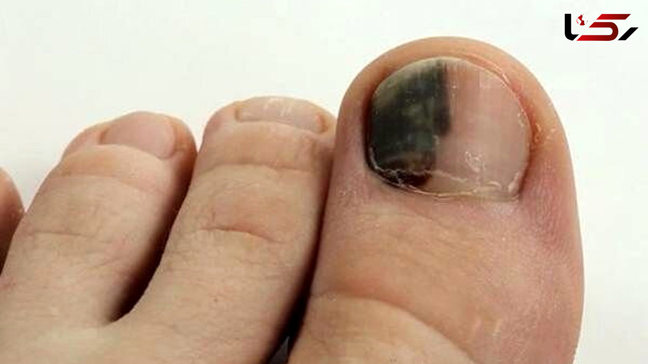 دلایل، علائم و درمان سیاهی ناخن پا