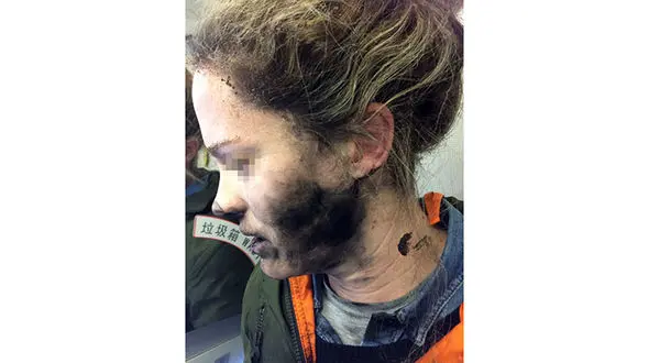 انفجار هدفون سر و صورت دختر جوان را سوزاند!+عکس