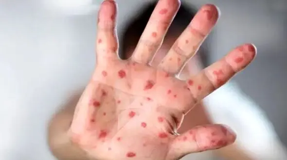 آنفلوآنزای گوجه‌فرنگی چیست؟+ علائم