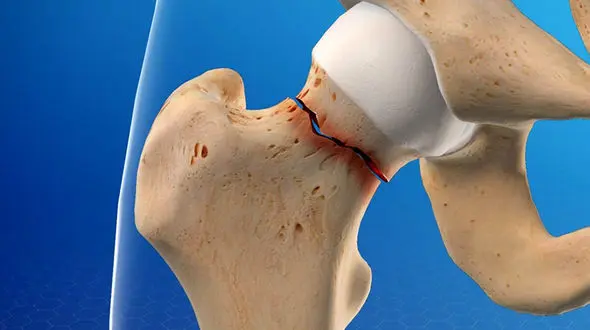 جراحی تعویض لگن انسان + فیلم