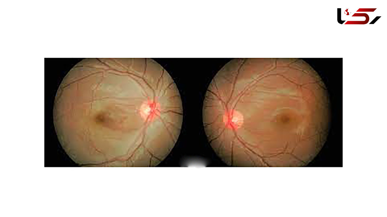 سکته چشم چیست؟ / درمان سکته چشم چگونه است؟