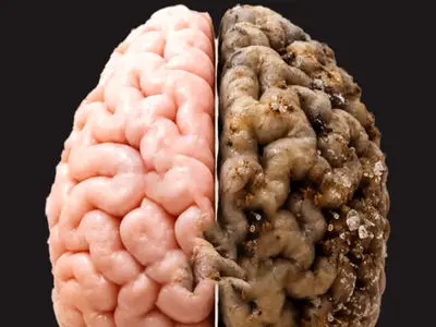 آیا شکر واقعا مغز را کوچک می‌ کند؟