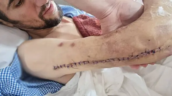 دستگاه الماس تراش دست کارگر یزدی را جدا کرد / عمل پیوند موفقیت آمیز شد + عکس