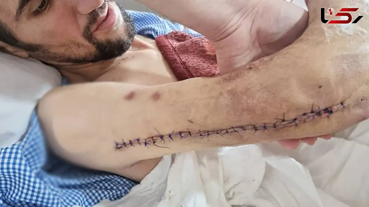 دستگاه الماس تراش دست کارگر یزدی را جدا کرد / عمل پیوند موفقیت آمیز شد + عکس
