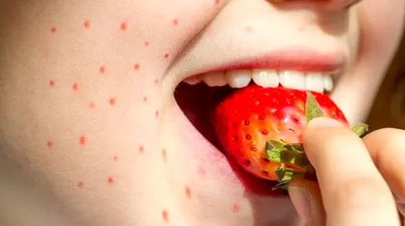 آیا به توت فرنگی حساسیت دارید؟ علائم رایج و راه‌ های پیشگیری
