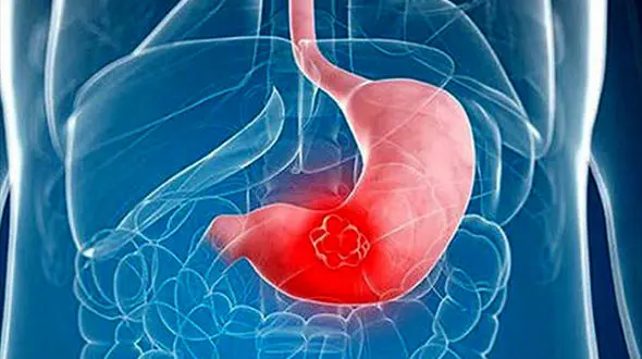 شایع‌ترین سرطان بین مردان ایرانی؛ سرطان معده